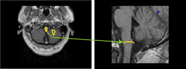 Activity in brainstem and cerebellum25