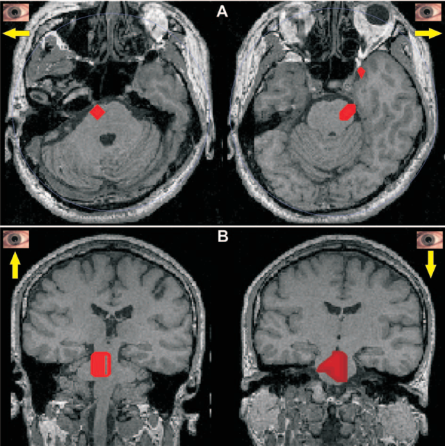 Response in brain stem